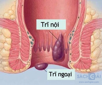 Bệnh trĩ: Nguyên nhân và thuốc điều trị