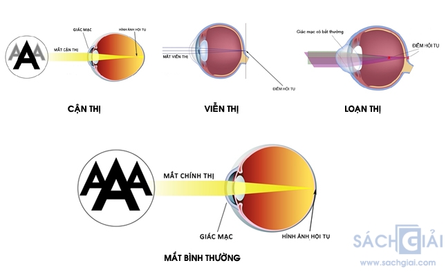 Tật khúc xạ ở mắt